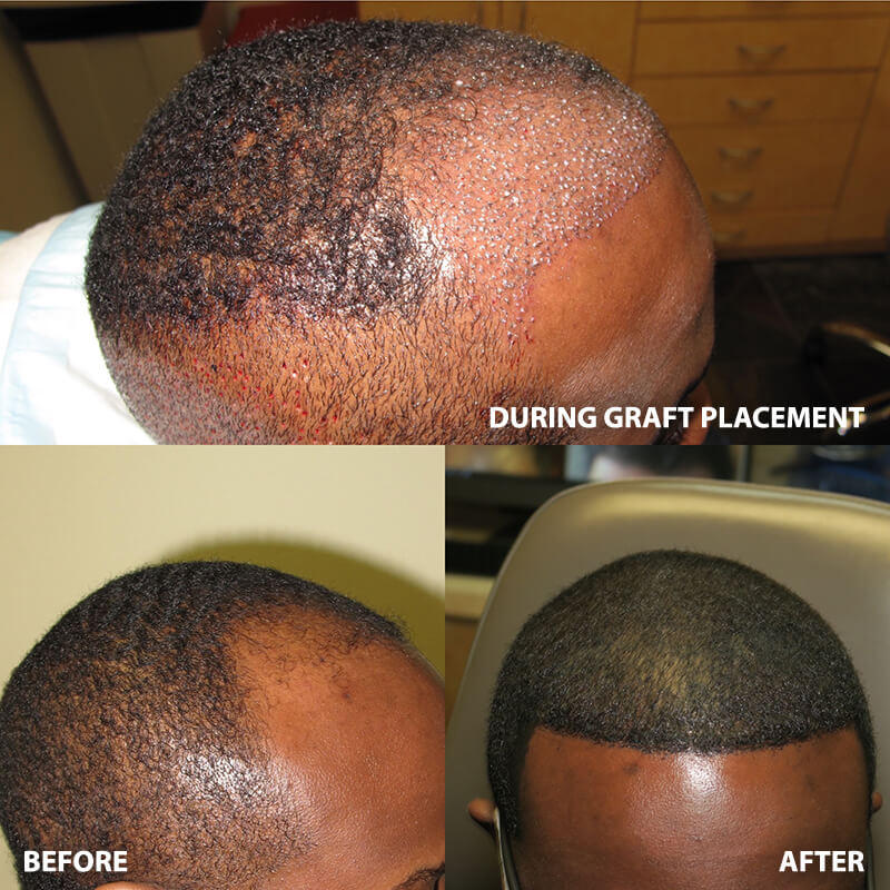 artas-hair-restoration-before-after-6652-01
