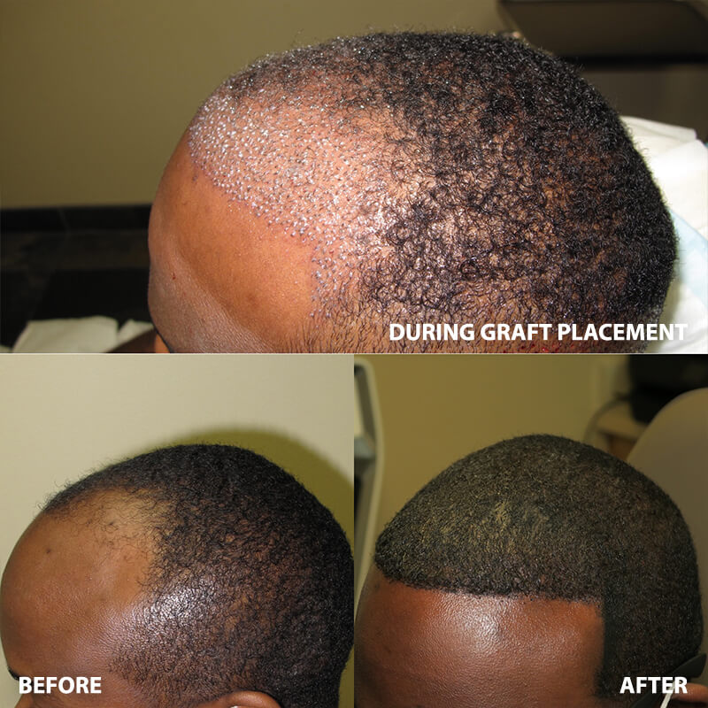 artas-hair-restoration-before-after-6652-02