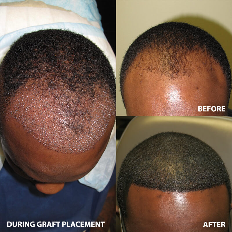 artas-hair-restoration-before-after-6652-03
